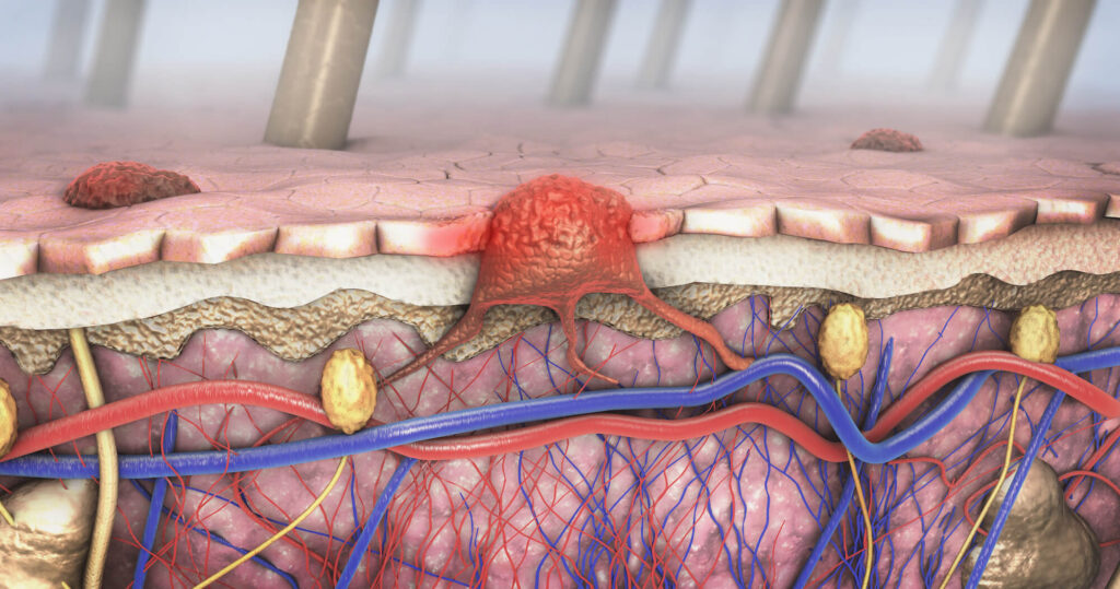 Mole mapping for cancer and other skin diseases